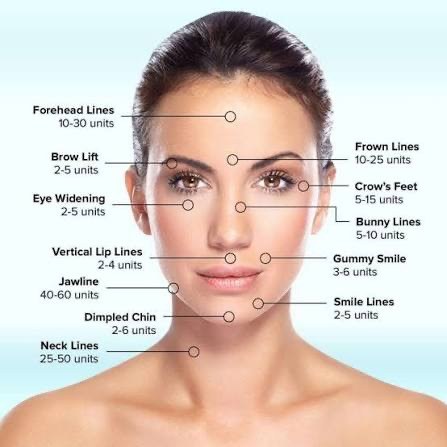 Typical unit ranges by facial area, from forehead lines to neck lines